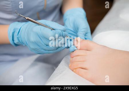 Traitement de l'infection fongique de l'ongle de pied de la femme par podologue. Banque D'Images