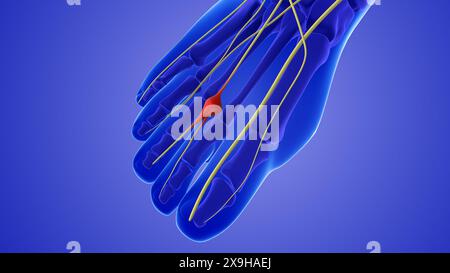 Animation médicale d'un névrome ou d'un nerf pincé Banque D'Images