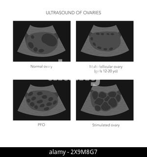 Illustration vectorielle médicale de l'échographie des ovaires avec des images d'ovaires normales, polykystiques et stimulées. Illustration vectorielle Illustration de Vecteur
