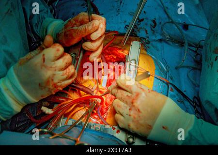 Une salle d’opération est occupée par une équipe de médecins pratiquant la chirurgie cardiaque Banque D'Images