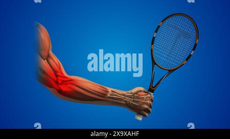 Tennis elbow zone de douleur inflammation Banque D'Images