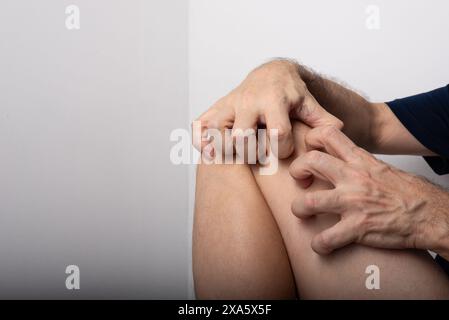 Homme grattant entre le genou et la jambe. Maladie de la peau. Réaction allergique. Dermatologie. Isolé sur fond blanc. Banque D'Images