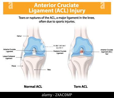 Comparaison de l'ACL normal et déchiré dans le genou Illustration de Vecteur