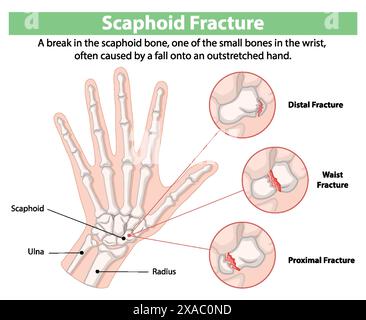 Illustration de fractures du scaphoïde du poignet Illustration de Vecteur