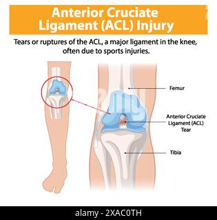Illustration d'une déchirure du LCA dans l'articulation du genou Illustration de Vecteur