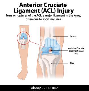 Illustration d'une déchirure ACL dans le genou Illustration de Vecteur