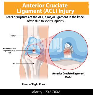 Illustration d'une déchirure de la LCA dans le genou droit Illustration de Vecteur