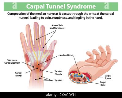 Schéma détaillé des symptômes du syndrome du canal carpien Illustration de Vecteur