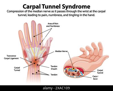 Schéma détaillé des symptômes du syndrome du canal carpien Illustration de Vecteur