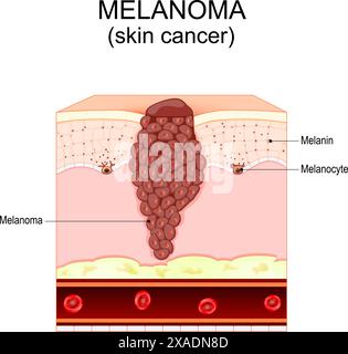 Mélanome. Cancer de la peau qui provient de mélanocytes. Couches et structure de la peau humaine. Section transversale de la peau. Illustration vectorielle Illustration de Vecteur