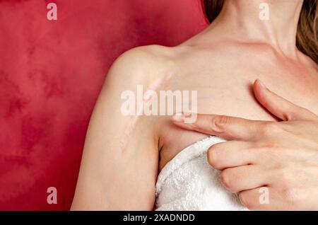 Cicatrice postopératoire sur l'épaule d'une femme. Une femme montre la cicatrice. Cicatrice après chirurgie après fracture osseuse du bras. Banque D'Images