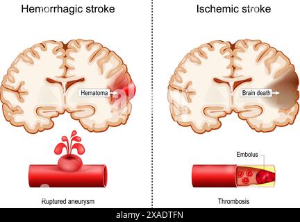 Accidents vasculaires cérébraux hémorragiques et ischémiques. Infarctus cérébral. Coupes transversales du cerveau humain avec hématome et une partie de la mort cérébrale. Gros plan du vaisseau sanguin avec Illustration de Vecteur