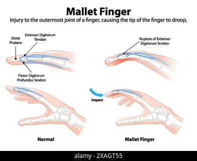 Diagramme montrant les conditions normales et les doigts de maillet Illustration de Vecteur