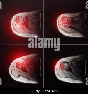 Imagerie IRM de l'articulation de l'épaule après fracture et luxation. Fracture d'empreinte de la tête humérale. Blessure à l'épaule, entorse, synovite. Le rouge Banque D'Images