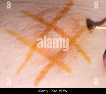 Application d'une maille d'iode au joint après injection intramusculaire du médicament. Traitement des infiltrats post-injection Banque D'Images