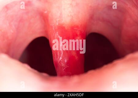 Luette longue avec inflammation des infections et des virus. Traitement des uvulites de l'enfant et de l'adulte. Mal de gorge, mal de gorge. Banque D'Images