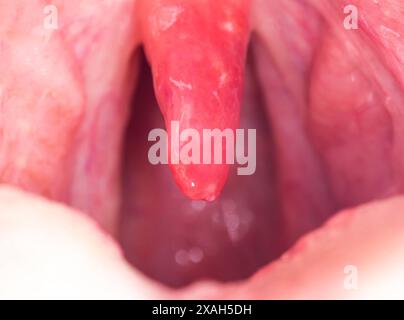 Luette longue avec inflammation des infections et des virus. Traitement des uvulites de l'enfant et de l'adulte. Mal de gorge, mal de gorge. Banque D'Images