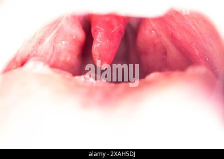 Uvulite et mal de gorge dans la cavité buccale dus à la maladie. Inflammation de la luette et des amygdales due à des infections pendant la maladie, gros plan Banque D'Images