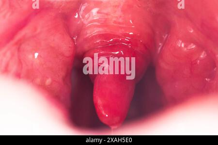 Uvulite et mal de gorge dans la cavité buccale dus à la maladie. Inflammation de la luette et des amygdales due à des infections pendant la maladie, gros plan. Allergie Banque D'Images