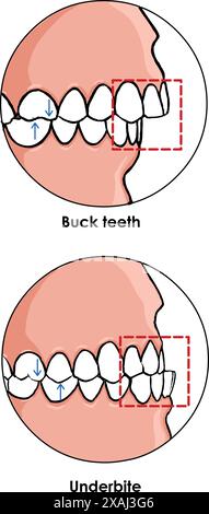 Dent en version Bucco positionnement vers l'extérieur des dents saillantes Illustration de Vecteur