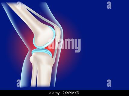 Inflammation de l'articulation du genou. Genou humain réaliste sur fond bleu. Illustration vectorielle conceptuelle Illustration de Vecteur