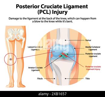 Illustration d'une lésion PCL au genou Illustration de Vecteur