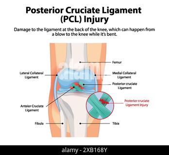 Illustration d'une lésion PCL au genou Illustration de Vecteur
