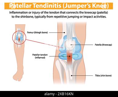 Inflammation du tendon rotulien due à des sauts répétitifs Illustration de Vecteur