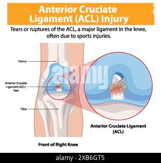 Illustration d'une déchirure de la LCA dans le genou droit Illustration de Vecteur
