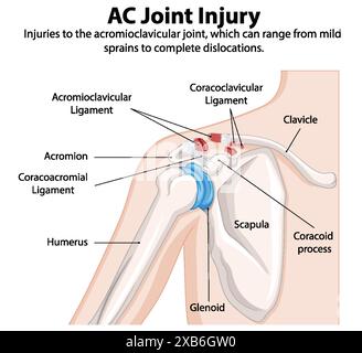 Illustration détaillée d'une lésion articulaire de l'épaule Illustration de Vecteur