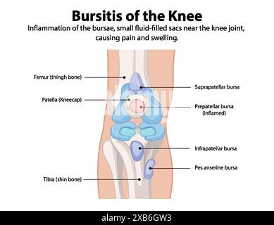 Inflammation de la bourse du genou causant douleur et gonflement Illustration de Vecteur