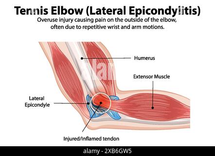 Schéma détaillé de l'état du tennis elbow Illustration de Vecteur