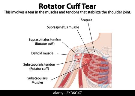 Anatomie détaillée de la déchirure de la coiffe des rotateurs de l'épaule Illustration de Vecteur