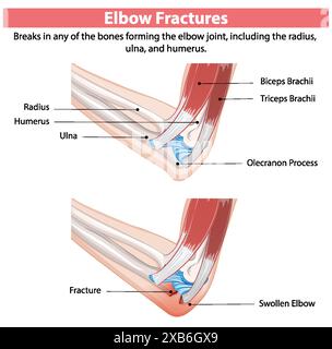 Schéma montrant les types de fractures du coude Illustration de Vecteur