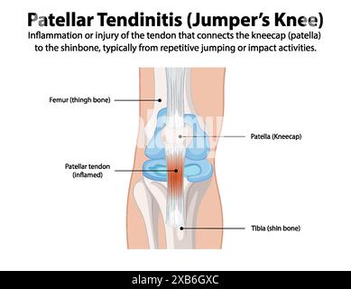 Inflammation du tendon rotulien due à des activités répétitives Illustration de Vecteur