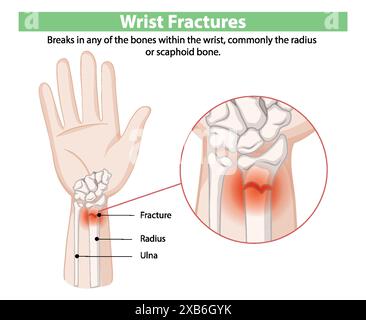 Illustration des fractures du poignet et des os affectés Illustration de Vecteur