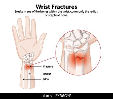 Illustration des fractures du poignet et des os affectés Illustration de Vecteur