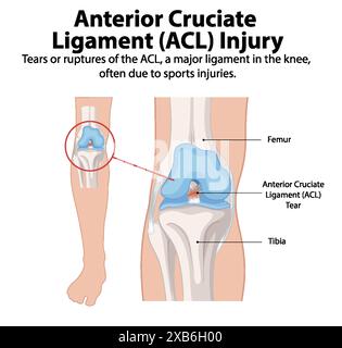Illustration d'une déchirure ACL dans le genou Illustration de Vecteur