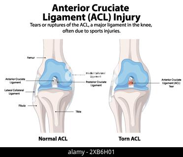 Comparaison de l'ACL normal et déchiré dans le genou Illustration de Vecteur