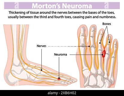 Diagramme montrant l'épaississement nerveux dans le pied Illustration de Vecteur