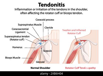 Illustration des tendons normaux et enflammés de l'épaule Illustration de Vecteur