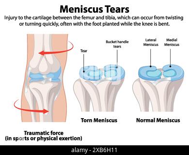 Illustration d'un ménisque déchiré et normal dans le genou Illustration de Vecteur