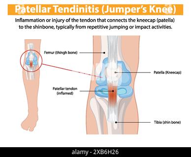 Inflammation du tendon rotulien due à des sauts répétitifs Illustration de Vecteur