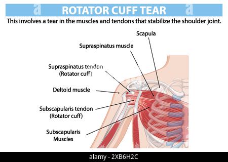 Anatomie détaillée de la déchirure de la coiffe des rotateurs de l'épaule Illustration de Vecteur