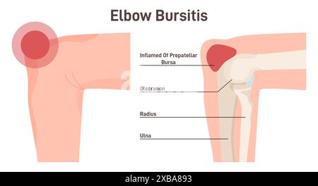 Bursite. Inflammation de l'articulation du coude. Burses enflammées ou irritées du liquide synovial. Pathologie musculo-squelettique. Illustration vectorielle plate Illustration de Vecteur