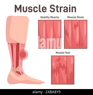 Lésion musculaire de jambe. Tension musculaire à différents stades, saine, tendue et déchirée. Schéma didactique de l'anatomie du système musculaire humain. Illustration vectorielle plate Illustration de Vecteur