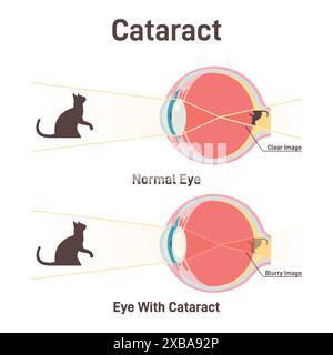 Cataracte. Opacification de la lentille, diminution de la vision. Structure anatomique en coupe transversale d'un oeil normal et d'un oeil avec cataracte. Illustration vectorielle plate Illustration de Vecteur