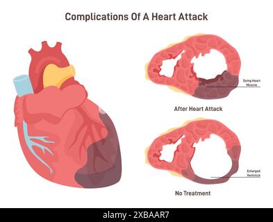 Complications des crises cardiaques. Amincissement de la paroi cardiaque et élargissement ventriculaire. Cellules musculaires du myocarde mourantes. Illustration vectorielle plate Illustration de Vecteur