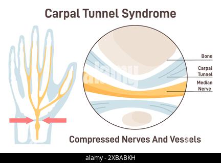 Syndrome du canal carpien. Nerf médian comprimé. Anatomie du canal carpien. Sensations des doigts, du pouce et de la paume. Illustration vectorielle plate Illustration de Vecteur