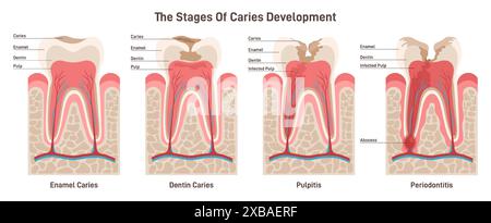 Le développement de la carie. Stades de la maladie dentaire : caries de l'émail et de la dentine, pulpite et parodontite. Carie dentaire. Problème d'hygiène buccale. Affiche de formation dentaire. Illustration vectorielle plate Illustration de Vecteur